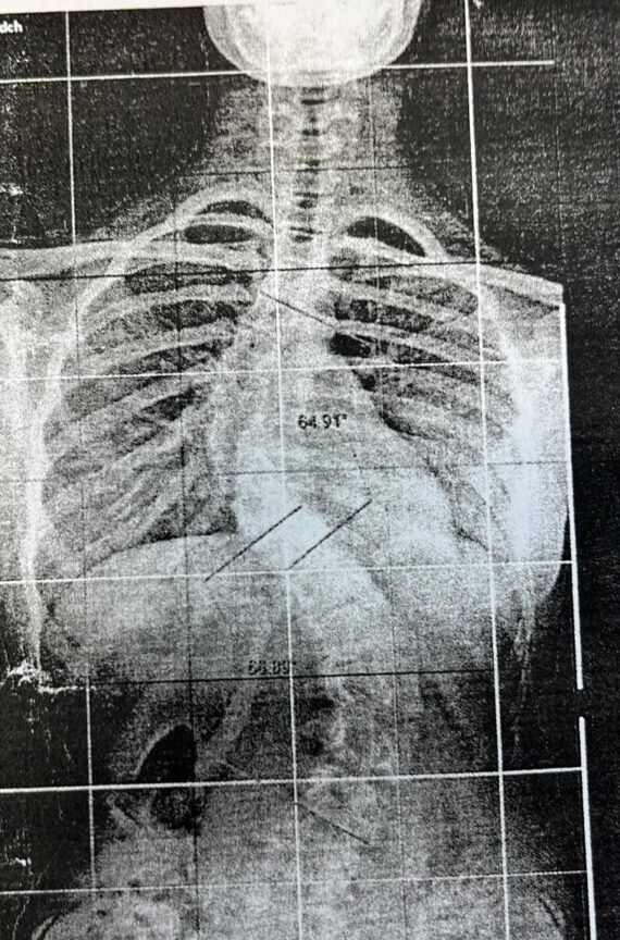 Radiografia, escoliosis con 64,91 grados
