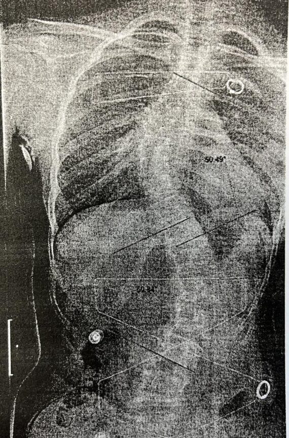 Radiografia, escoliosis con corsé, 50,49 grados